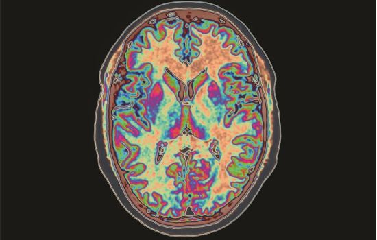 Droga que combate Alzheimer volta à cena como nova promessa