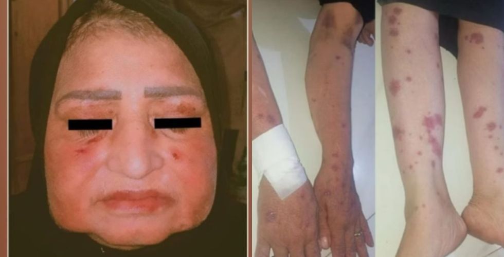Ibuprofeno causa reação alérgica grave e faz mulher chorar lagrimas de pus.