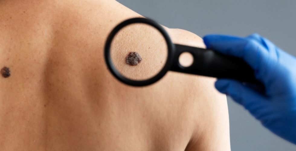 Homens e mulheres desenvolvem câncer de pele em regiões diferentes do corpo