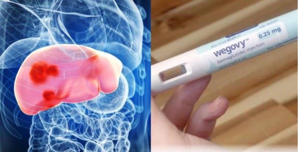 Anvisa aprova semaglutida para tratar doença hepática metabólica