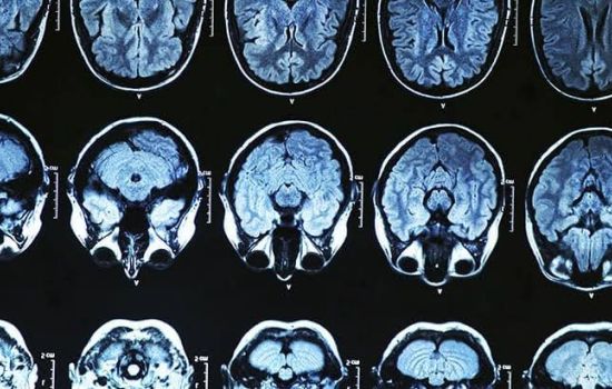 Anvisa aprova novo medicamento para o tratamento do Alzheimer