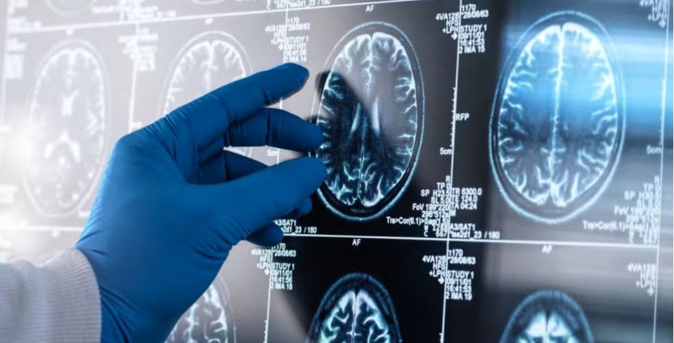 Estudo brasileiro revela que a inflamação no cérebro pode ser a chave para a progressão do Alzheimer.