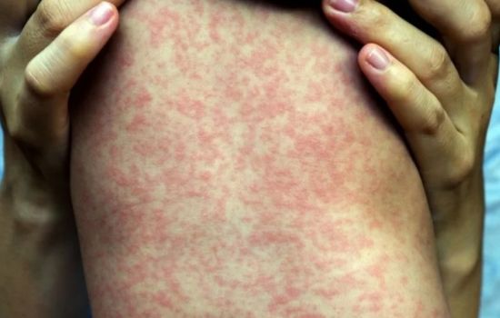 Sarampo volta a ameaçar o Brasil e farmacêutico ganha protagonismo na prevenção e identificação de casos
