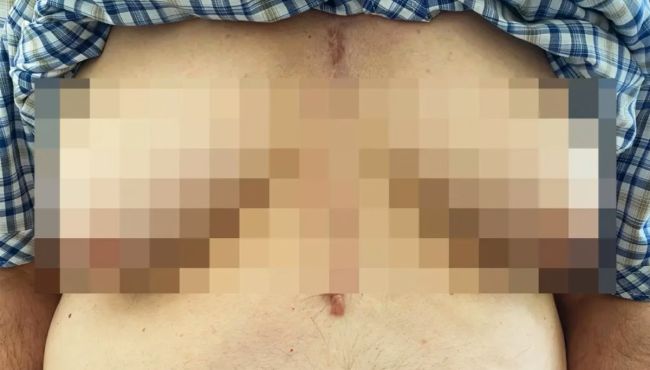 Uso de espironolactona é associado à ginecomastia em pacientes idosos