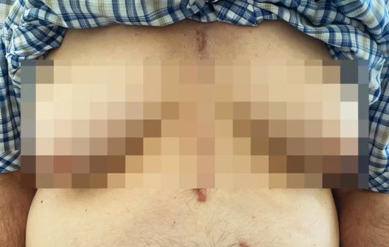 Uso de espironolactona é associado à ginecomastia em pacientes idosos