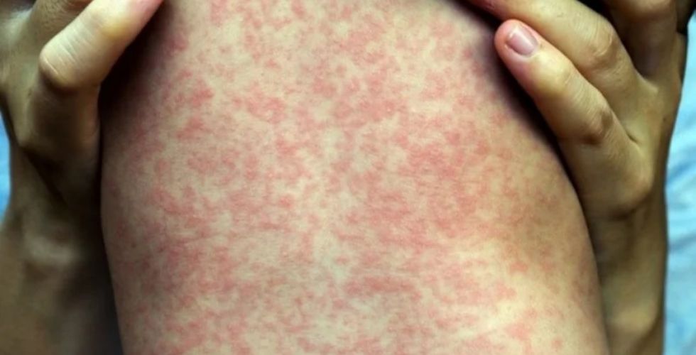 Sarampo volta a ameaçar o Brasil e farmacêutico ganha protagonismo na prevenção e identificação de casos