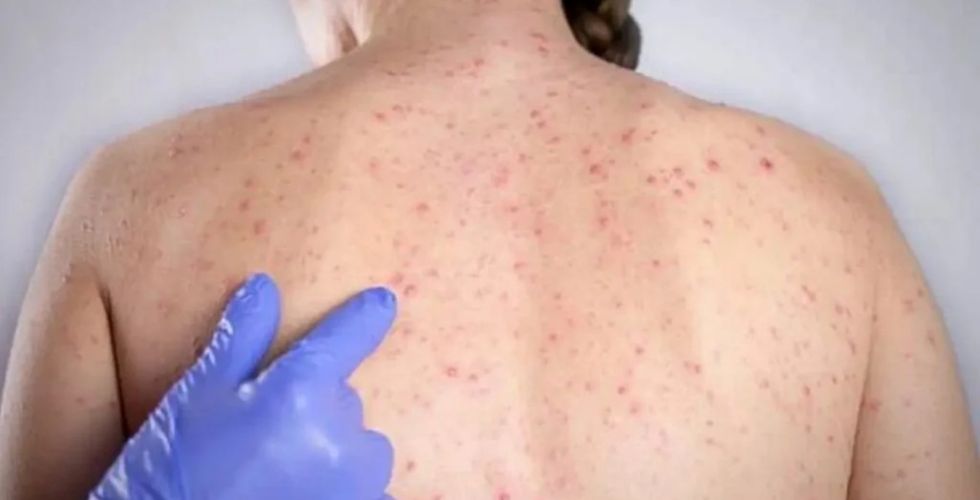 16 casos de sarampo expõem risco sanitário e pressionam vacinação em São Paulo