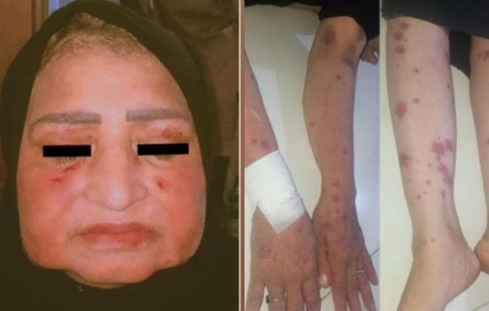 Ibuprofeno causa reação alérgica grave e faz mulher chorar lagrimas de pus.