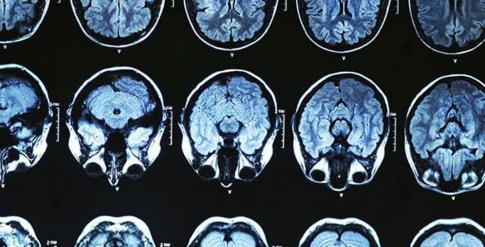Anvisa aprova novo medicamento para o tratamento do Alzheimer