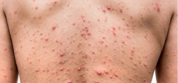Casos de sífilis crescem no Brasil e acendem alerta para avanço da doença