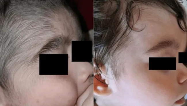 Contato indireto com minoxidil provoca 'síndrome do lobisomem' em 11 bebês