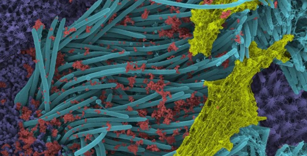 Imagens impressionantes mostram infecção por coronavírus nas células das vias respiratórias