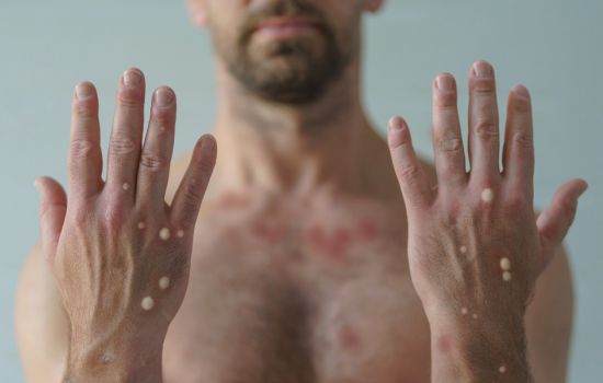 Mpox atinge novos estados e Brasil soma 90 confirmações