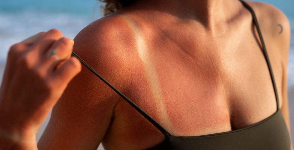Movimento anti-protetor solar cresce: farmacêutico reforça alerta contra fake news e câncer de pele